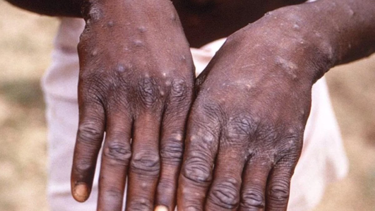 Filipinler’de maymun çiçeği virüsü alarmı: 1 kişi enfekte oldu