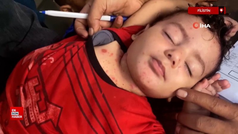 Gazze’de cilt hastalıkları çocuklar arasında yayılıyor