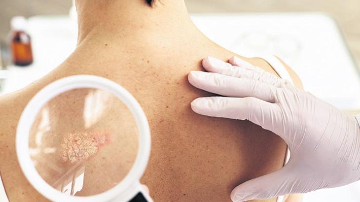 ‘Sedef’ zengin hastalığı mı?